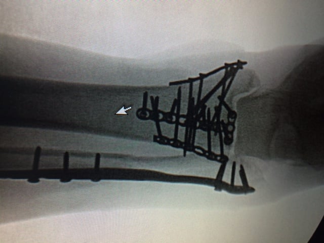 Patient image of: Larry Nipon