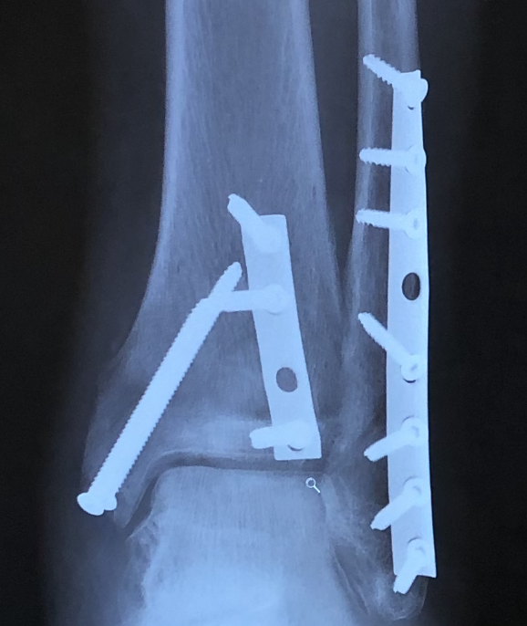Patient image of: Lou M.