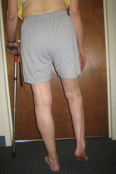 Before photo of Correction of foot deformity with ankle fusion