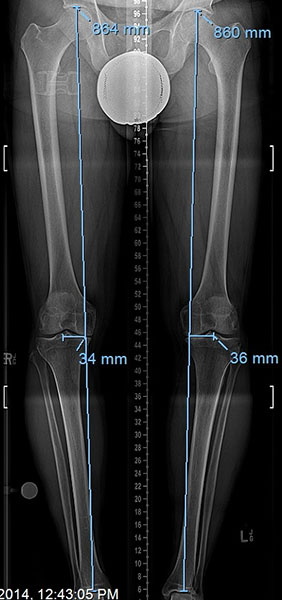 Before photo of Knee Realignment and Joint Preservation
