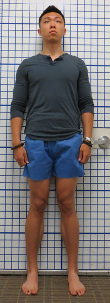 Before photo of Knock Knee