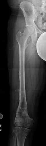 After photos of Femoral Reconstruction in a Soccer Player