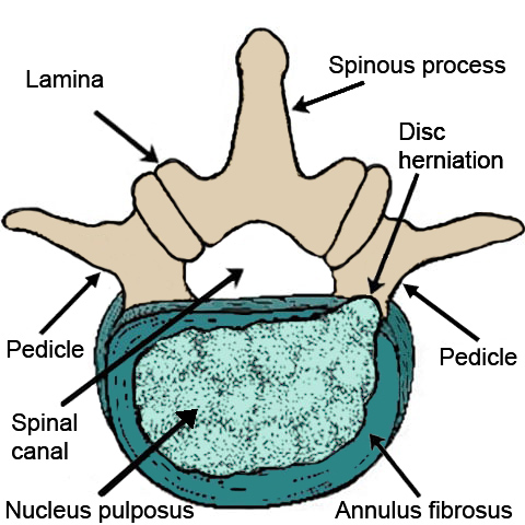 Diagram of a lumbar disc herniation.