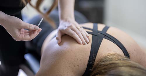 acupuncture