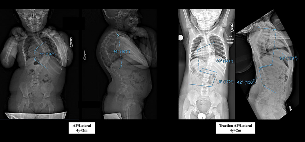 Figure 1 - Anteroposterior (AP) radiographs at presentation: standing (left) and traction (right).