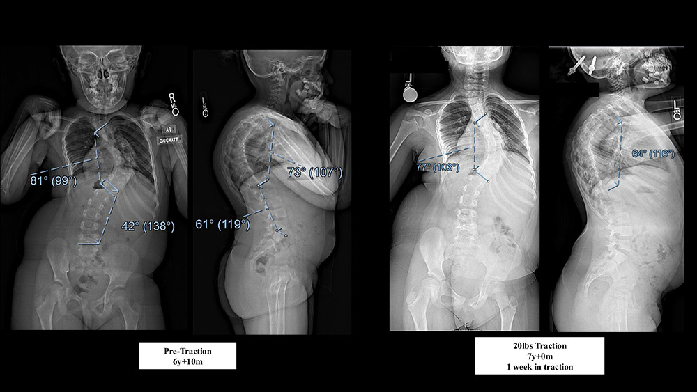 Figure 3 - AP/lateral radiographs before skeletal traction (left) and after 20 lbs. of traction were applied (right)