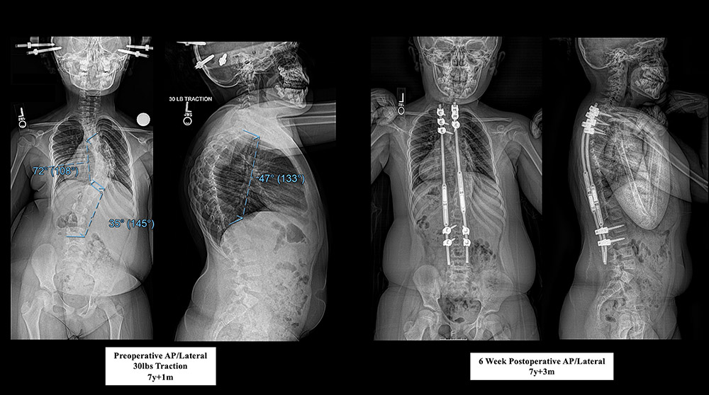 Figure 4 - Preoperative standing radiographs in 30 lbs. of skeletal traction (left); 6-week postoperative radiographs