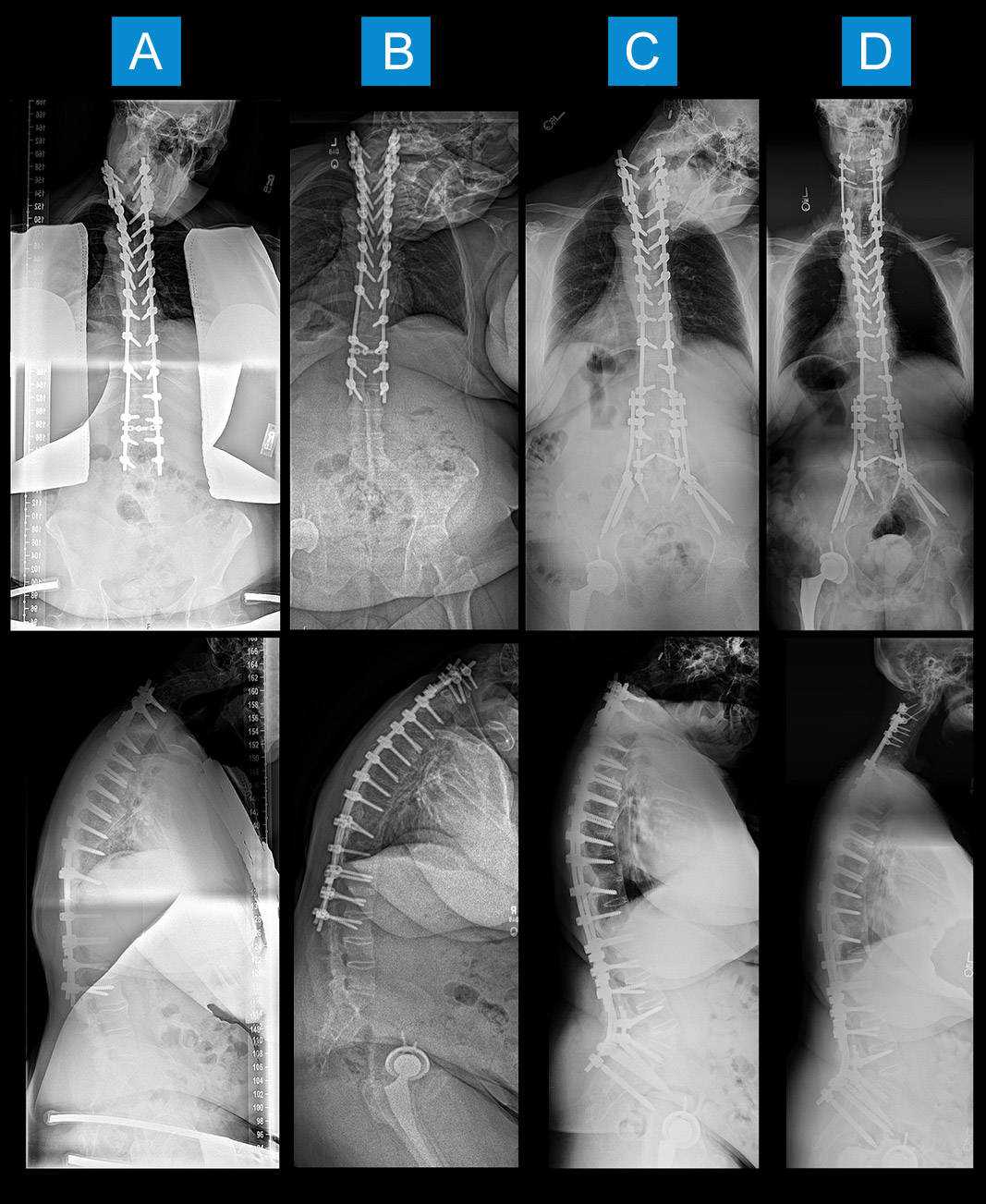 Figure 1 - Full-length standing anteroposterior (top row) and lateral (bottom row) radiographs