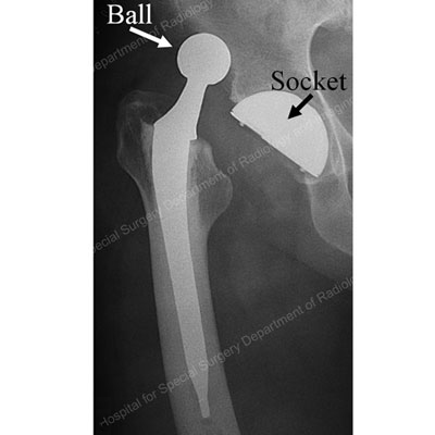 Anteroposterior (front to back) X-ray view of the pelvis with a posterior dislocation of the left hip