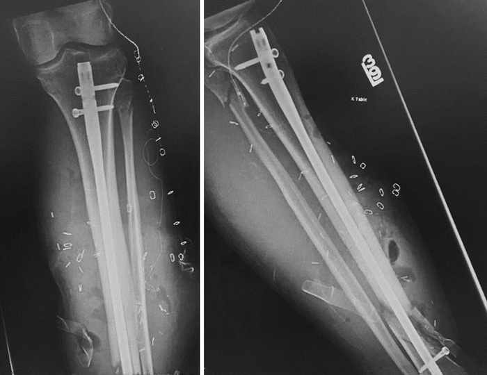 X-rays postsurgery at a non-HSS center