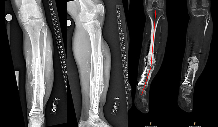 X-rays before revision surgery showing nonunion, deformity and cellular death of bone tissue
