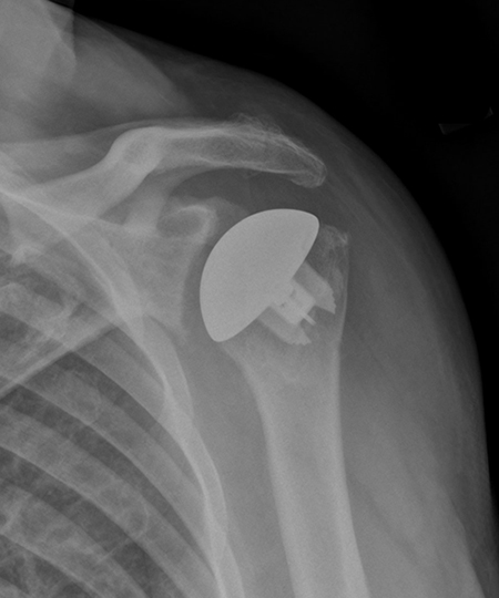 X-ray of an anatomic total shoulder replacement with a modern, stemless implant.