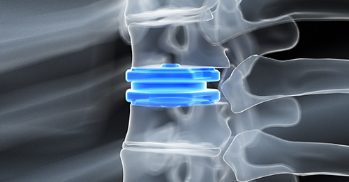 Computer illustration of disc replacement.