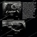 Two stacked sonographic images of left index finger for case 185