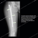 Ultrasound thumbnail image of case 188 - Radiograph of the right femur showing intramedullary nail