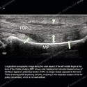 Ultrasound thumbnail image of case 190 - longitudinal sonographic image along the volar aspect of the left middle finger