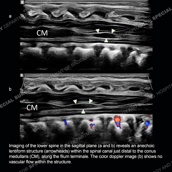 Ultrasound image of lower spine in sagittal plane