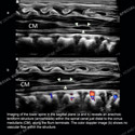 Ultrasound thumbnail image of case 192 - Lower spine in sagittal plane