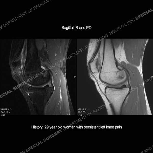 Sagittal IR and PD Image of Knee for Case 216