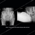 Radiograph Image of thigh area for Case 217