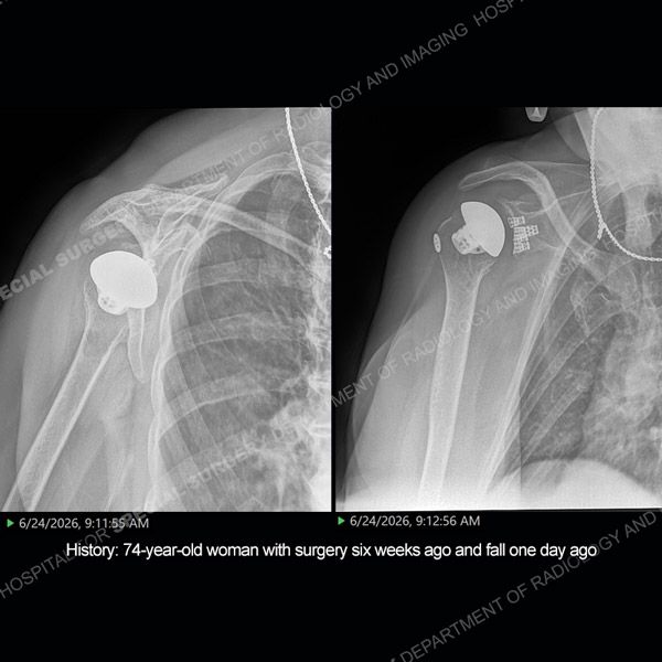 Side by side radiograph images of shoulder arthroplasty Case 219